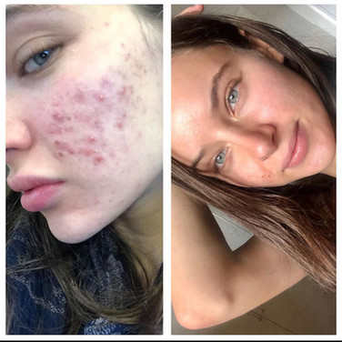 before-and-after-acne.jpg